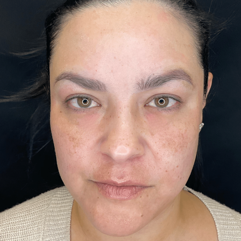 After Image: Scarlet RF Micronedling & Dermal Filler (undereye) - front