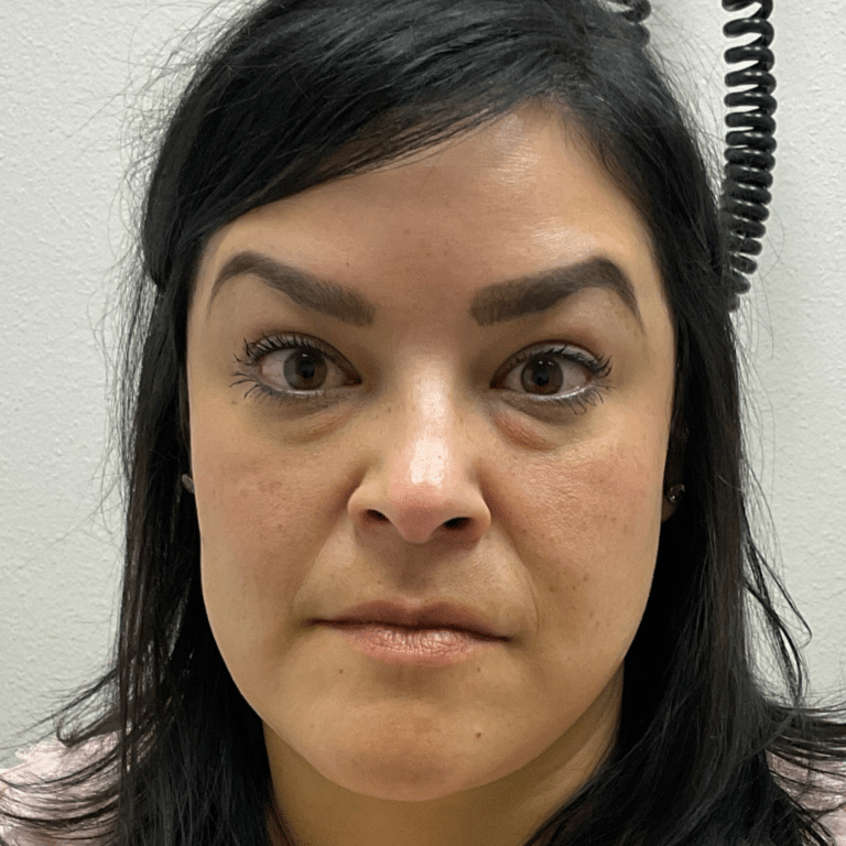 Before Image: Scarlet RF Micronedling & Dermal Filler (undereye) - front