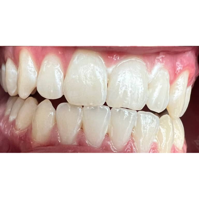 After Image: Teeth Whitening - front