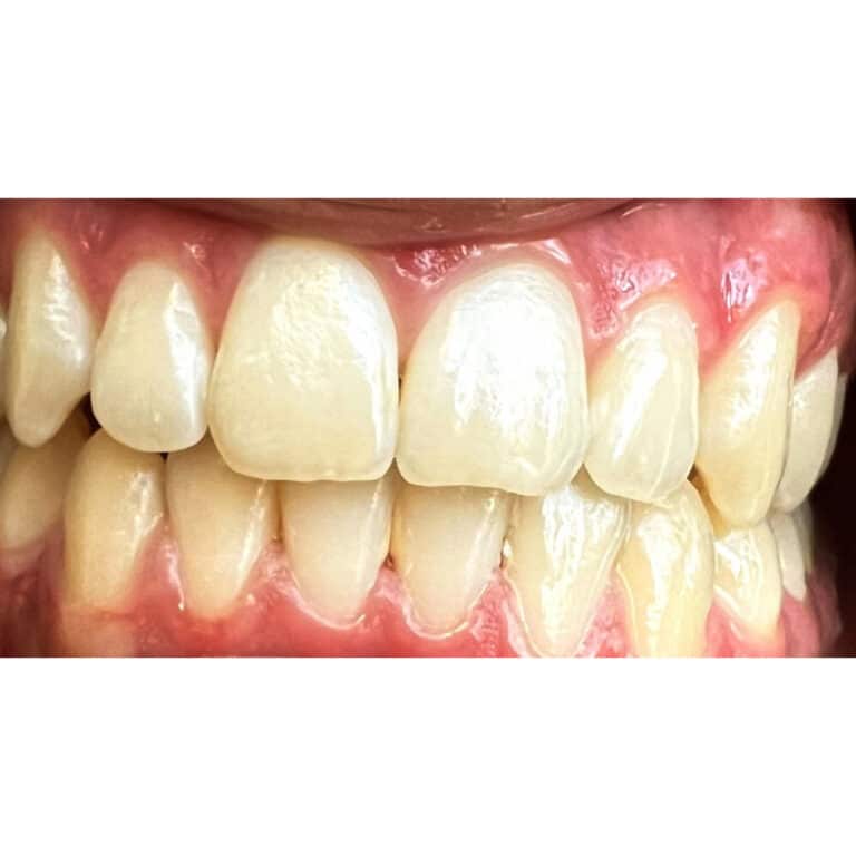Before Image: Teeth Whitening - front