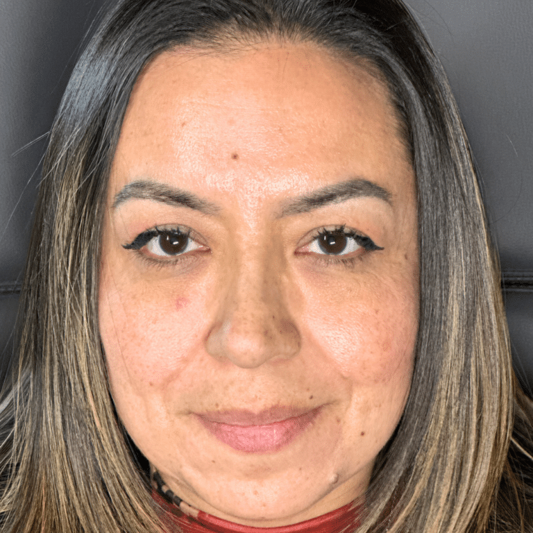 After Image: Scarlet RF Microneedling - front