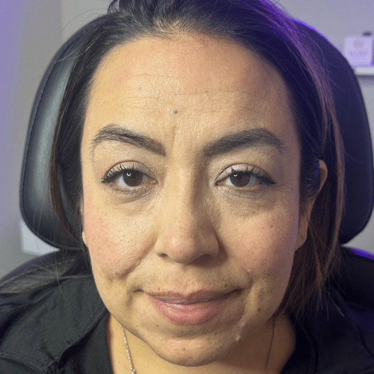 Before Image: Scarlet RF Microneedling - front