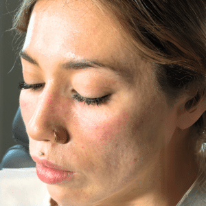 After Image: Dermal filler (undereye)