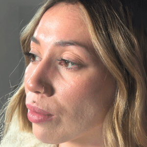 Before Image: Dermal filler (undereye)