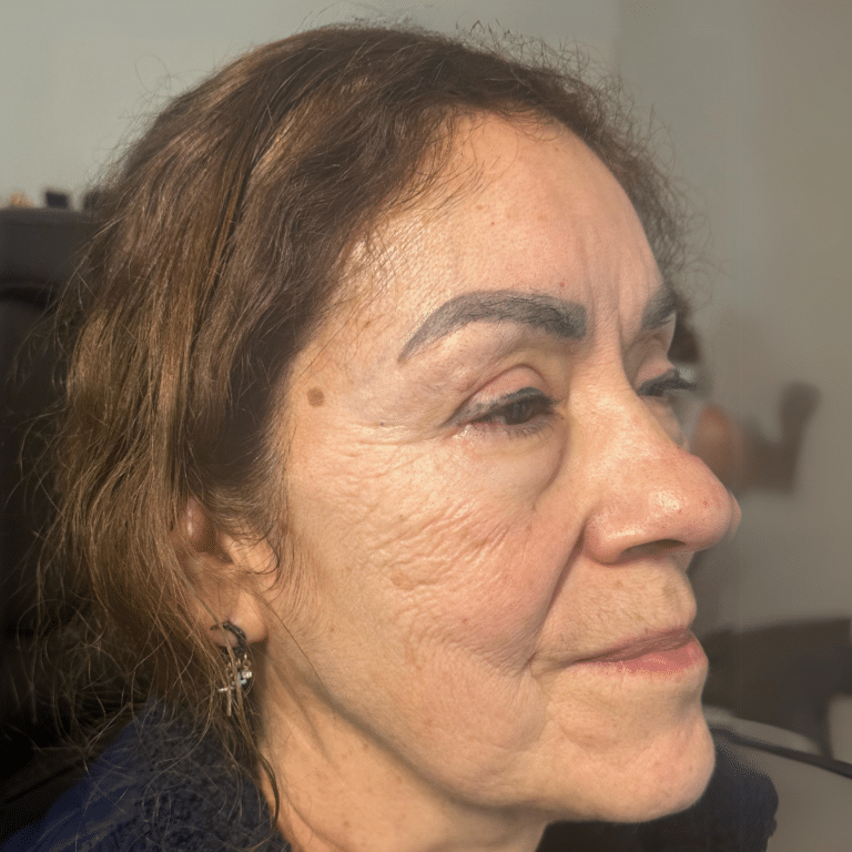 Before Image: Biostimulator - right-front-oblique