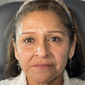 After Image: Dermal Filler (cheek)