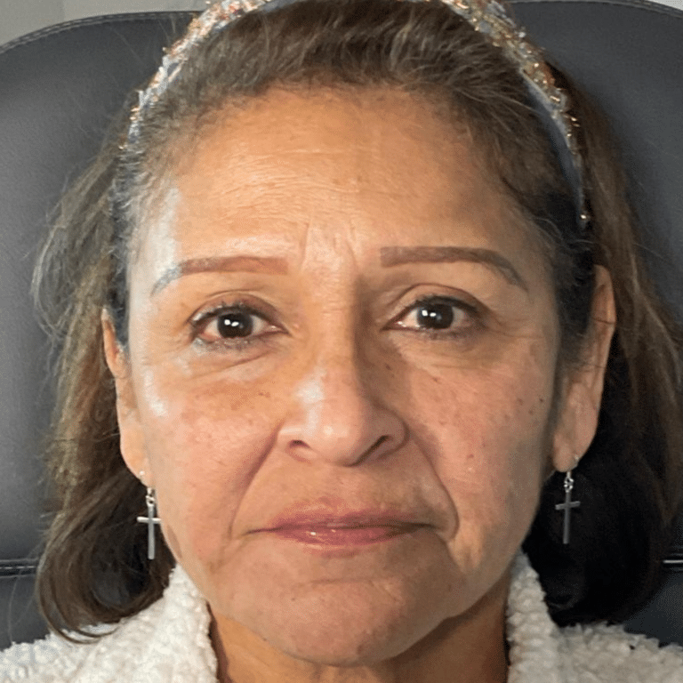 After Image: Dermal Filler (cheek) - front