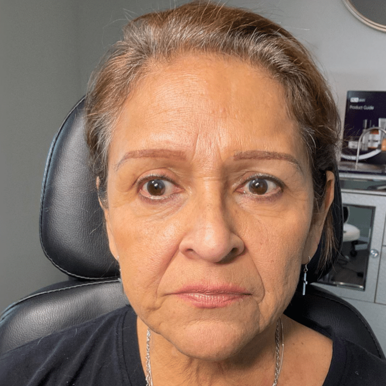 Before Image: Dermal Filler (cheek) - front