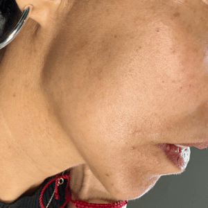 After Image: Dermal Filler (Jawline)