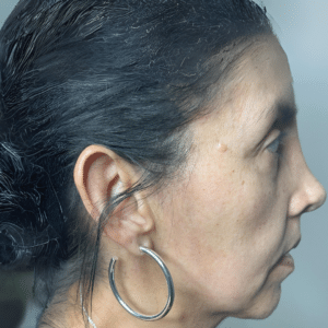 Before Image: Dermal Filler (Jawline)