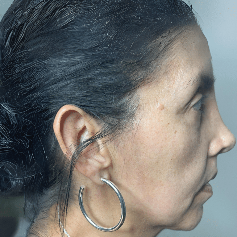 Before Image: Dermal Filler (Jawline) - right-side