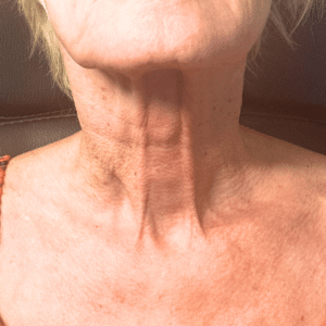 After Image: Scarlet RF Microneedling (Neck)