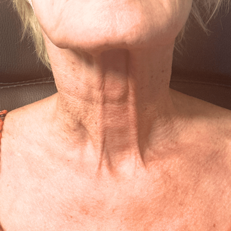 After Image: Scarlet RF Microneedling (Neck) - front