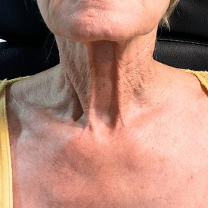 Before Image: Scarlet RF Microneedling (Neck)