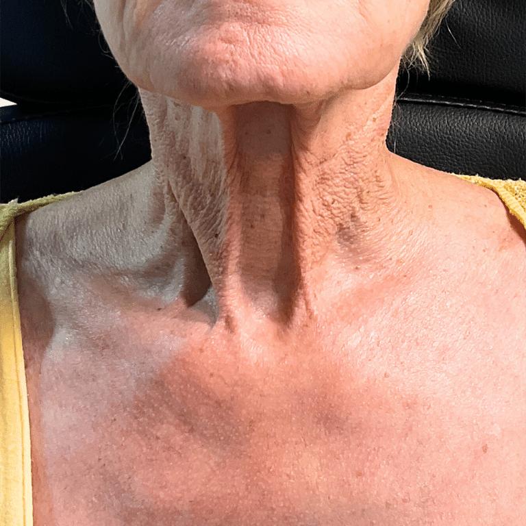 Before Image: Scarlet RF Microneedling (Neck) - front