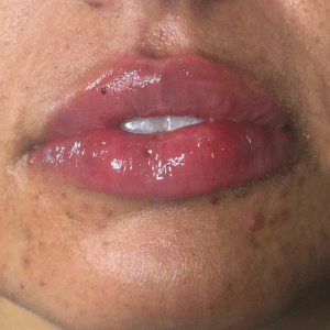 After Image: Dermal Filler (lips)