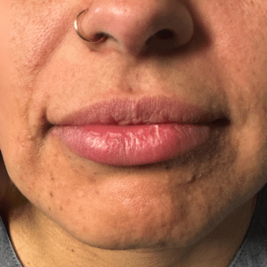 Before Image: Dermal Filler (lips)