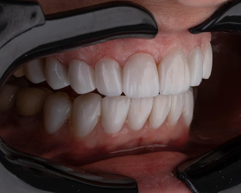 Top Beauty Enhancements: Why Tooth Gems Are Gaining Popularity