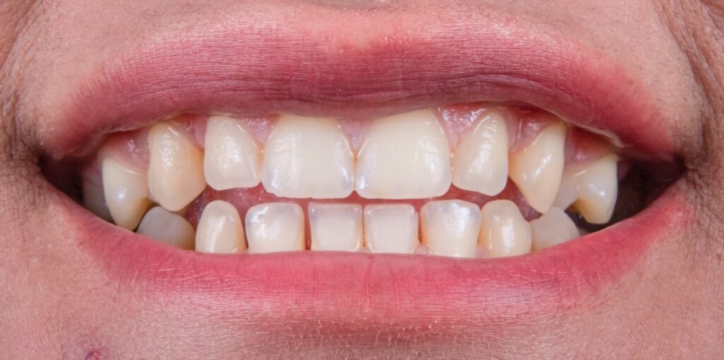 Teeth Whitening Solutions for a Dazzling Smile