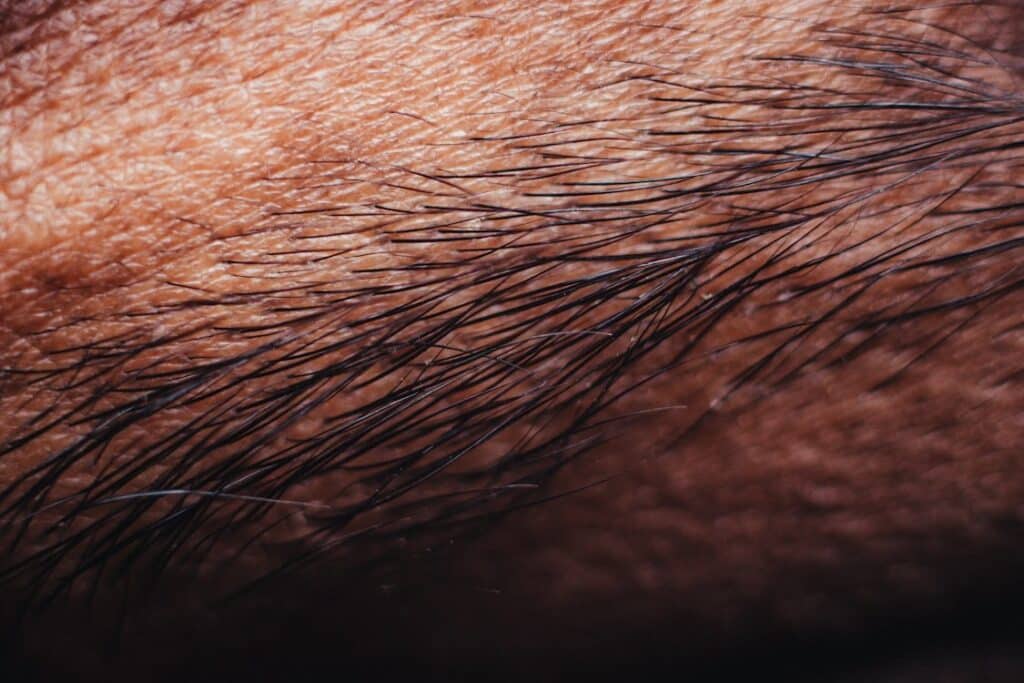 The Effectiveness of Collagen Induction Therapy for Aging Skin