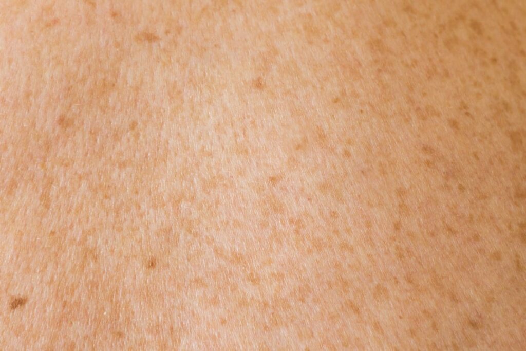 Top Benefits of Microneedling for Skin Rejuvenation
