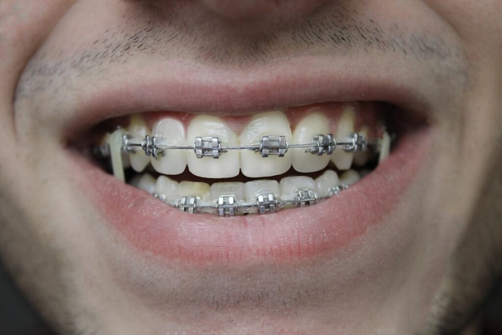 All You Need to Know About Tooth Gems
